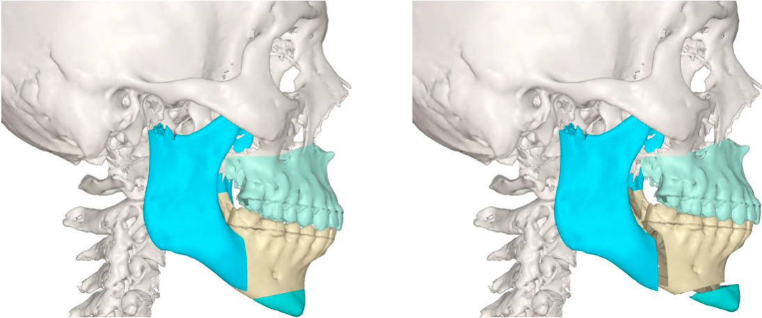 Mentoplastia